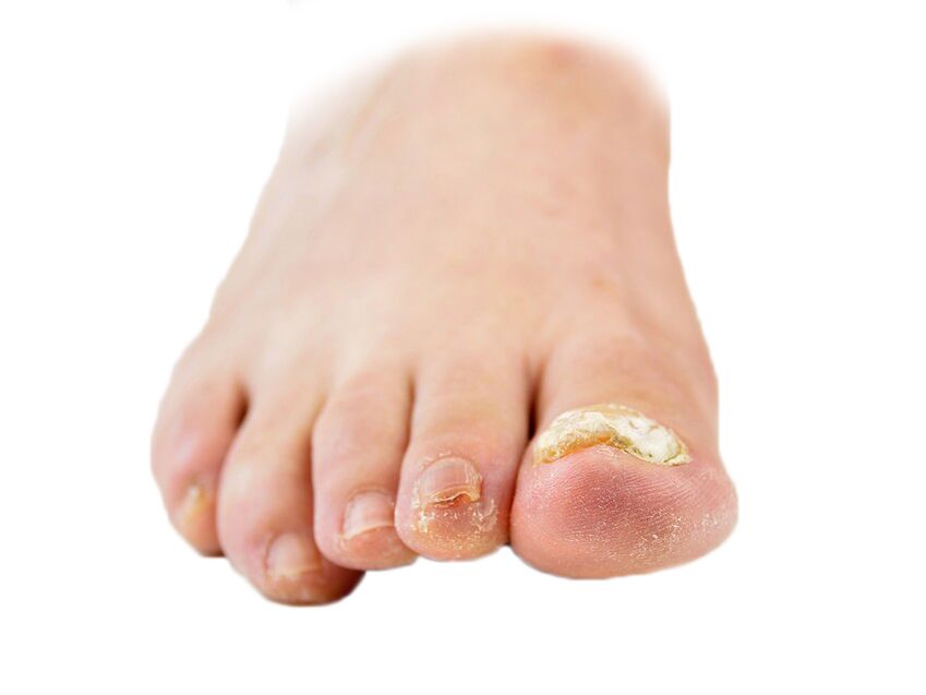 gombák köröm következményei nail gombusz a lábakon a legjobb kezelés