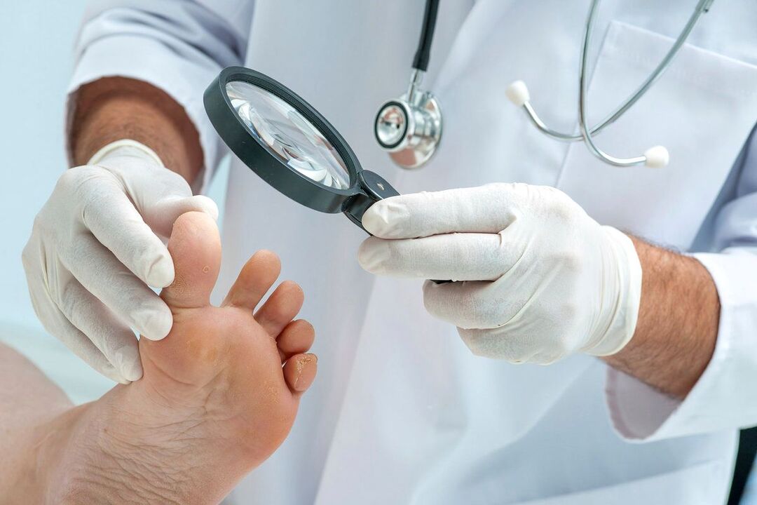 orvos megvizsgálja a lábát gombával