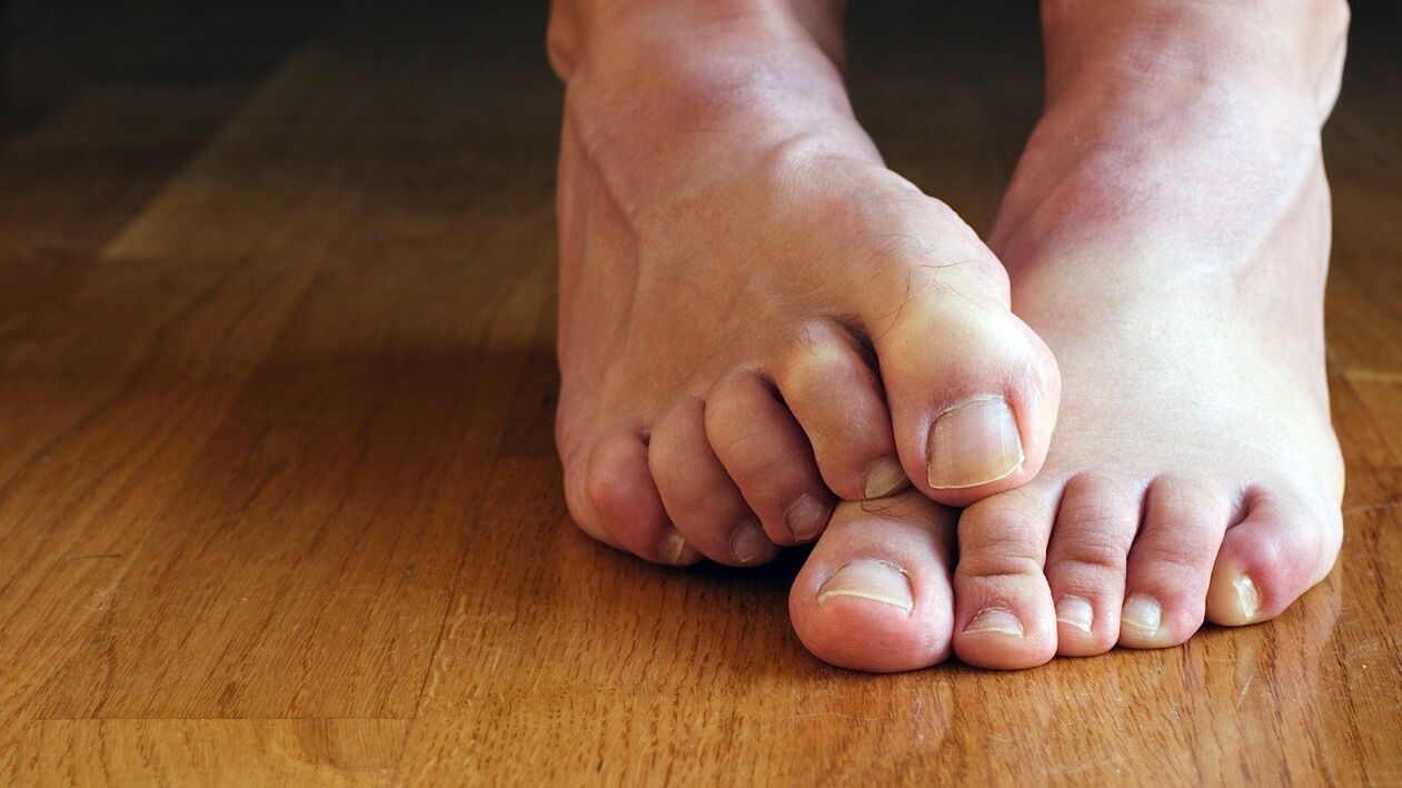 a láb bőrének viszketése gombával
