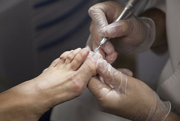 A lábak gomba diagnosztizálása