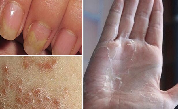Válthat -e a mycosis a test más részeire
