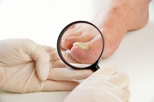 nail fungus treatment uk ki segített a gomba körmök